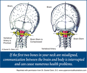 upper cervical misalignment